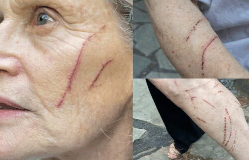 Katharine VanBuskirk says she was attacked by a raccoon over the weekend while letting her dogs out in a community yard.