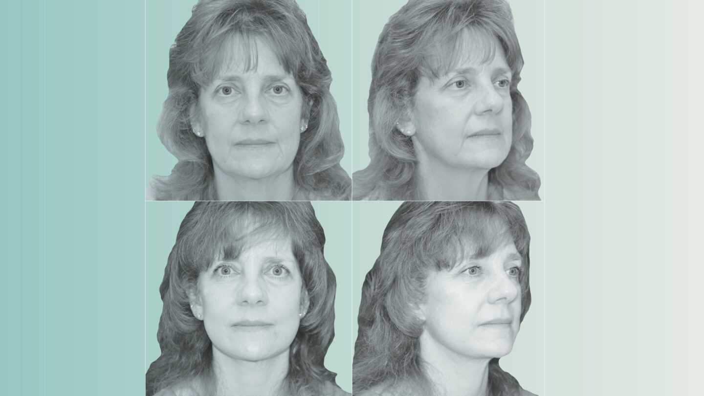 <i>Photo Illustration/CNN/Berlet Plastic Surgery via CNN Newsource</i><br/>Kimberly Bongiorno pictured before (top) and after (bottom) her face and neck lift.