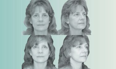 Kimberly Bongiorno pictured before (top) and after (bottom) her face and neck lift.