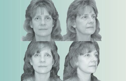 Kimberly Bongiorno pictured before (top) and after (bottom) her face and neck lift.
